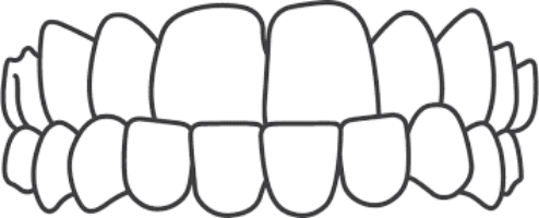 Graphic representing teeth with an underbite