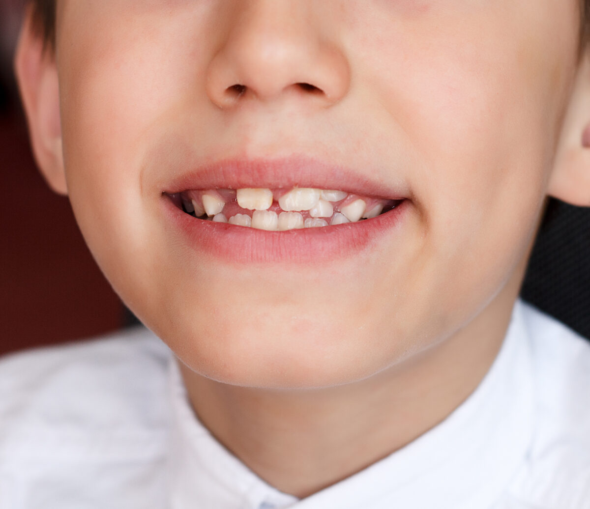 what causes crooked teeth