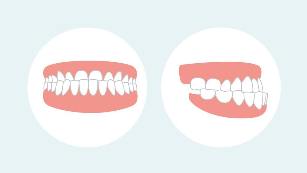 Understanding an underbite. Causes and treatment options