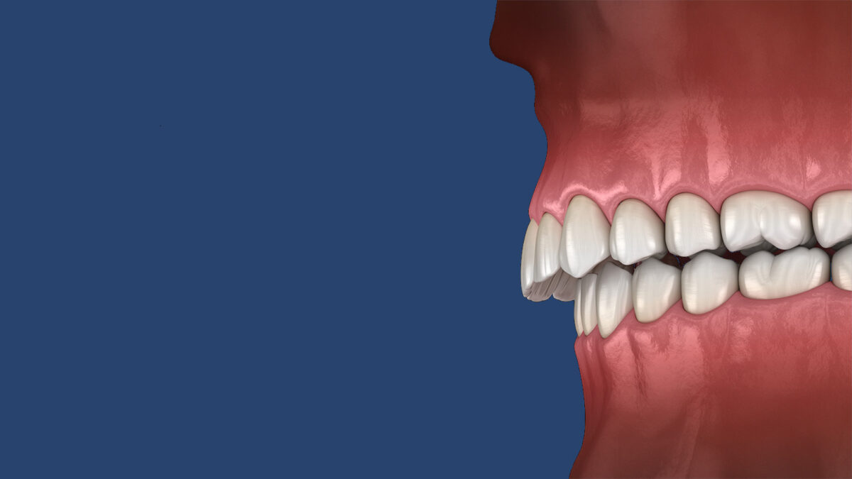 Illustration of what an overbite looks like.